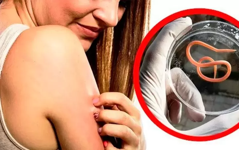 jeuk en irritatie door parasieten in het lichaam