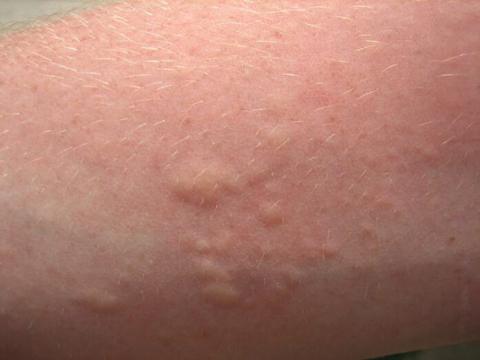 jeukende allergische huiduitslag kunnen symptomen zijn van ascariasis