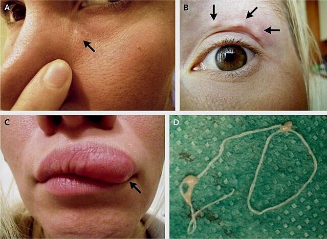 De belangrijkste manifestaties van dirofilariasis op het gezicht